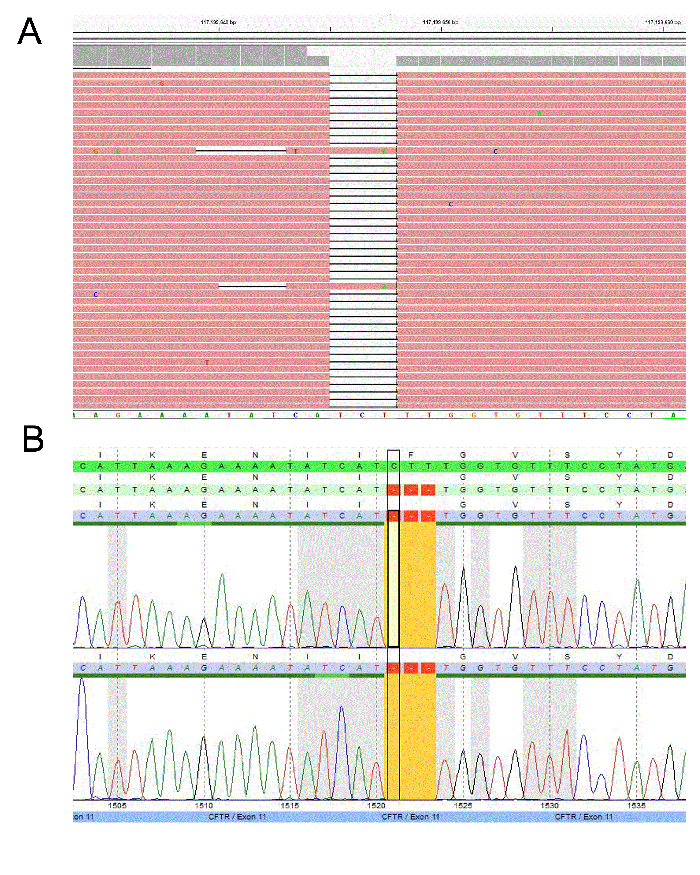 Figure 2: Example of a CFTR mutation detected by the TSCA NGS assay
(A) Homozygous small deletion at c.1521_1523delCTT (p.F508del) identified by NGS and (B) Sanger confirmed.